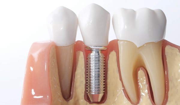 Implantologia-Clinica-Altea-studio-Dentistico-Viadana